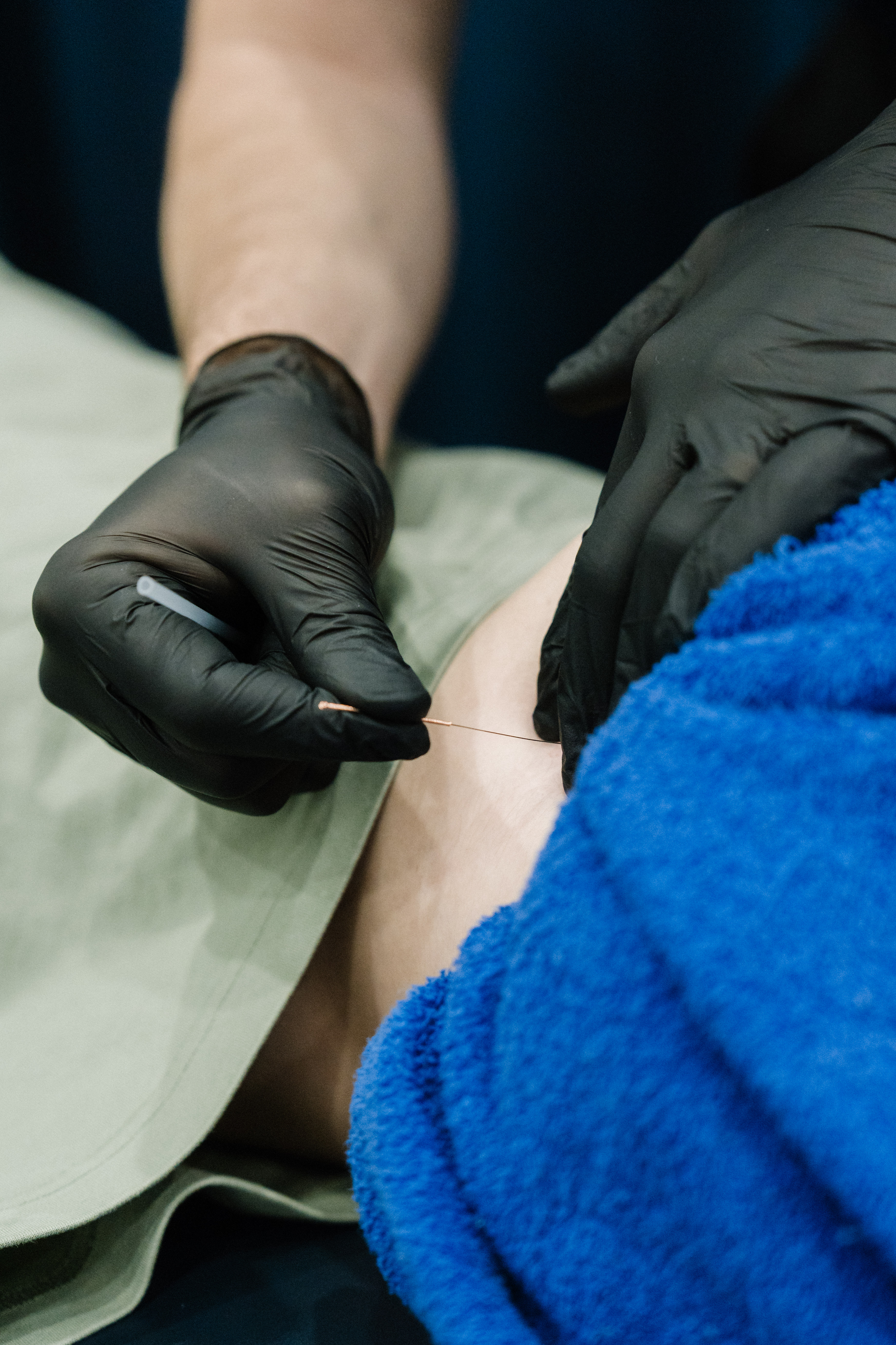 What Is Dry Needling? How It Works and What to Expect
